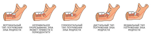 Kak mozhet. Схема удаления верхнего зуба мудрости. Угловое расположение зуба мудрости. Дистальный наклон зуба мудрости. Горизонтальное положение 8 зуба.