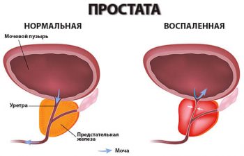 простатит у мужчин