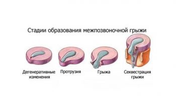 Межпозвоночная грыжа поясничного отдела позвоночника