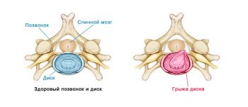 Межпозвоночная грыжа поясничного отдела позвоночника