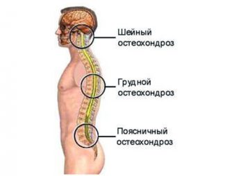 остеохондроз грудного отдела позвоночника