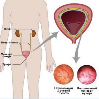 цистит у детей