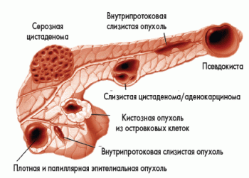 киста поджелудочной железы