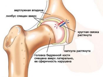 артроз тазобедренного сустава