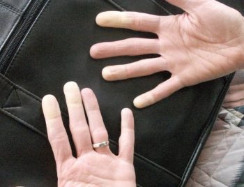 Почему трясутся руки: советы и рекомендации по диагностике и лечению