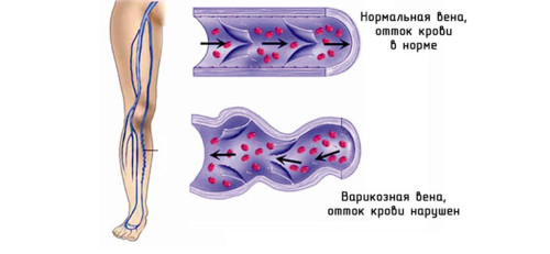 Почему при варикозе нельзя пить цикорий