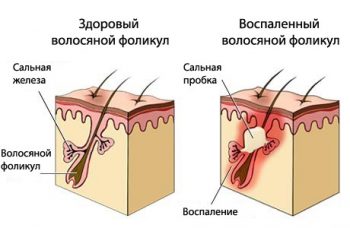 алопеция у детей