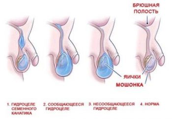 гидроцеле у мужчин