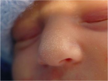 Везикупустулез новорожденных: симптомы и лечение
