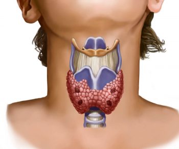 Увеличение щитовидной железы: симптомы, причины и последствия
