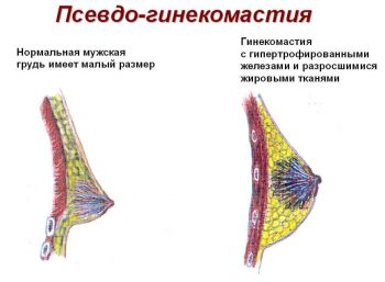 гинекомастия у мужчин