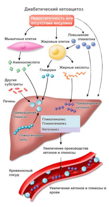 диабетический кетоацидоз