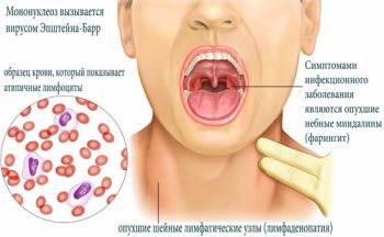 Инфекционный мононуклеоз у детей: симптомы и лечение