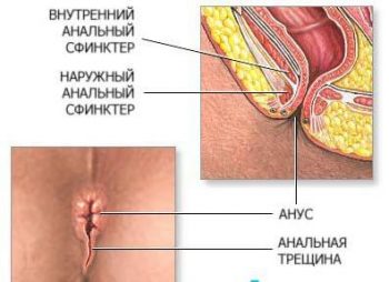 Как лечить трещины заднего прохода?