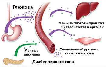 Гипергликемия: причины, симптомы и лечение