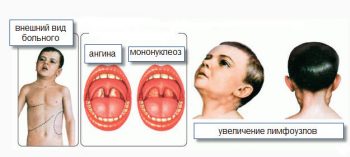 Инфекционный мононуклеоз у детей: симптомы и лечение