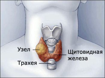 Увеличение щитовидной железы: симптомы, причины и последствия