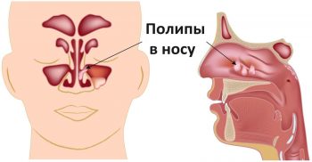 Полипы в носу: причины, симптомы и лечение