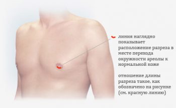 гинекомастия у мужчин