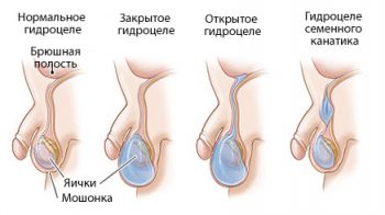 водянка яичек у мальчиков