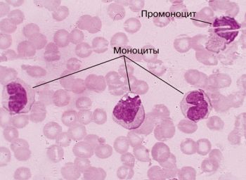 мегалобластная анемия