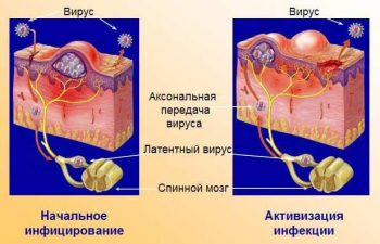 Герпес у детей: лечение в домашних условиях