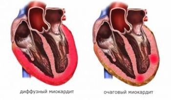 Миокардит у детей: симптомы, диагностика и лечение