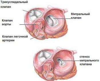 Митральные пороки сердца: диагностика и лечение