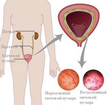 Цистит: обзор средств для снятия боли и воспаления