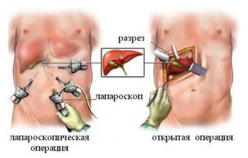 Хронический гепатит у детей: симптомы и лечение