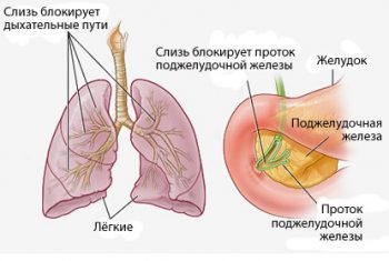 Муковисцидоз у детей: симптомы и лечение