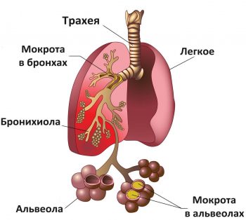 Пневмония у детей: причины, симптомы и лечение