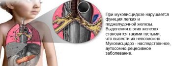Муковисцидоз у детей: симптомы и лечение