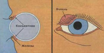 Ячмень на глазу у ребенка