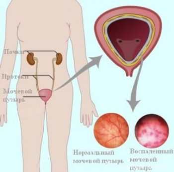 Профилактика цистита