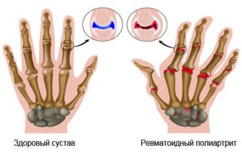 ревматоидный полиартрит