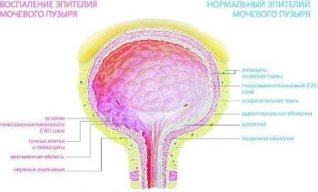 рецидивирующий цистит