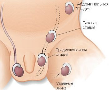 Крипторхизм у детей