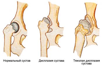 дисплазия тазобедренного сустава у детей