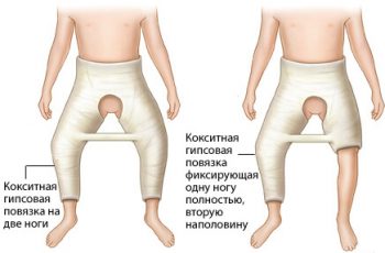 дисплазия тазобедренного сустава у детей