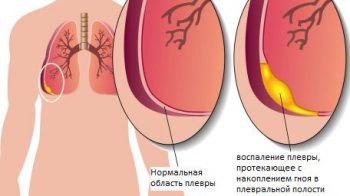 Плеврит у детей