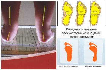 Плоскостопие у детей: причины возникновения, лечение и профилактика