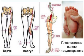 Плоскостопие у детей: причины возникновения, лечение и профилактика