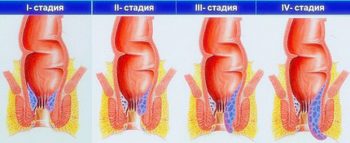 геморрой при беременности и после родов