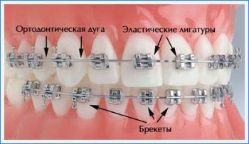 брекет-системы для детей