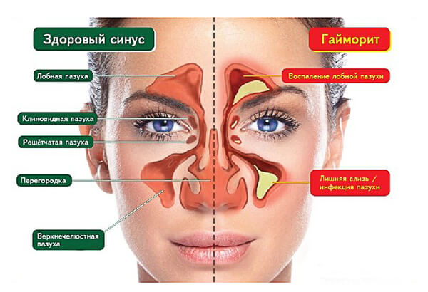 обзор средств для лечения гайморита