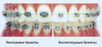 Брекеты для детей