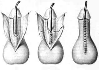 Гипоспадия у детей фото