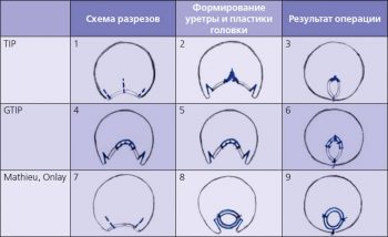 гипоспадия у детей