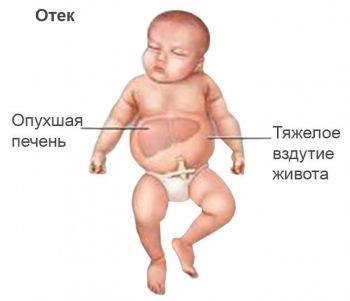 гемолитическая болезнь новорожденных